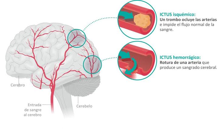 ictus isquémico en la infancia y adolescencia