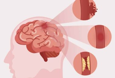ictus isquémico en la infancia y adolescencia