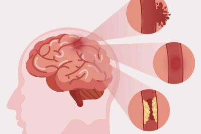 ictus isquémico en la infancia y adolescencia