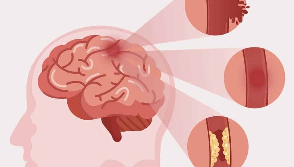 ictus isquémico en la infancia y adolescencia