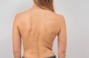 Pediatra explorando la espalda de una adolescente para detectar escoliosis idiopática
