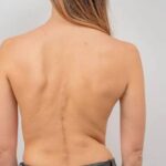 Pediatra explorando la espalda de una adolescente para detectar escoliosis idiopática