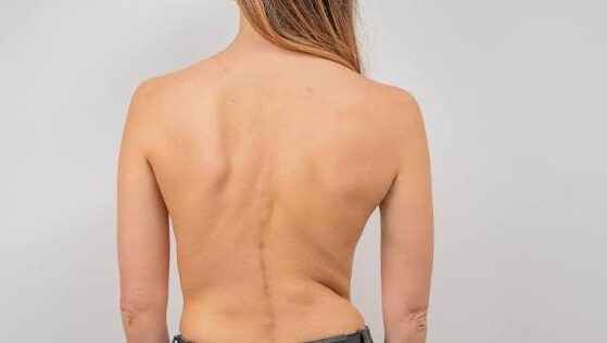 Pediatra explorando la espalda de una adolescente para detectar escoliosis idiopática