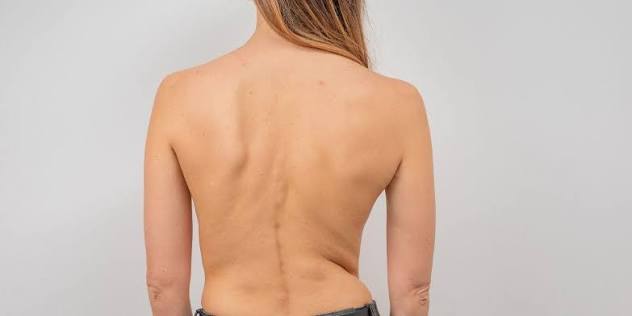 Pediatra explorando la espalda de una adolescente para detectar escoliosis idiopática