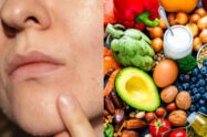 Adolescente con acné mirando un plato de comida saludable